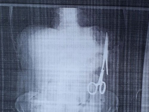 Truy tìm bác sĩ bỏ quên kéo trong bụng bệnh nhân 18 năm