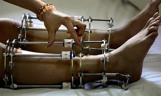 Giới trẻ Ấn Độ đổ xô đi phẫu thuật thẩm mỹ kéo dài chân