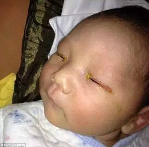 Xót xa em bé 3 tháng tuổi bị mù vì đèn flash của máy ảnh
