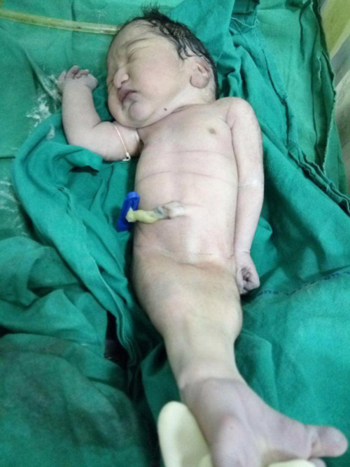 15 phút cuộc đời ngắn ngủi của em bé “người cá” sinh ra tại Ấn Độ