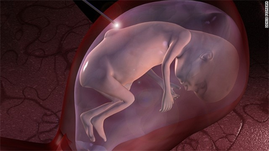 Công nghệ phẫu thuật bào thai ngay từ trong bụng mẹ