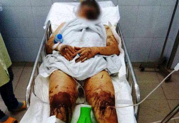 Quảng Ngãi: Bắt giữ kẻ lạ mặt tạt axit vào đôi nam nữ Việt Kiều về quê ăn Tết