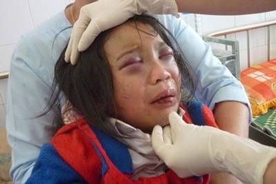 Bắt khẩn cấp cha nuôi hành hạ dã man bé gái 10 tuổi