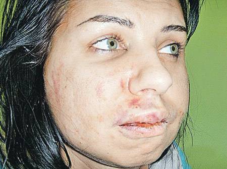 Một người mẫu bị chồng đánh đến thân tàn ma dại