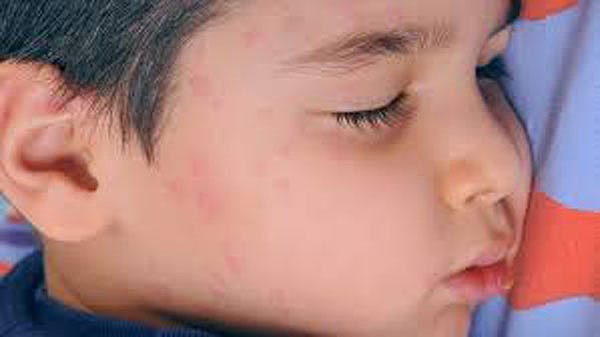 Dịch sởi bùng phát ở châu Âu