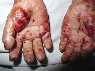 Phát hiện bệnh 'ma cà rồng' tại Việt Nam