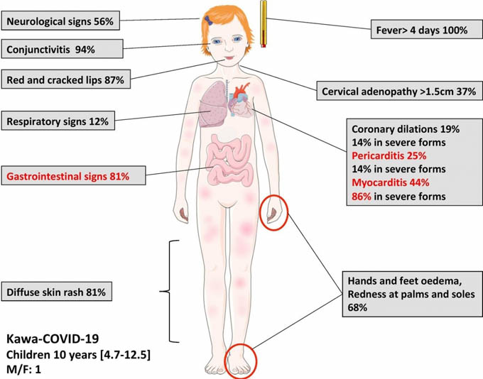 Australia ghi nhận bệnh nhân COVID-19 có hội chứng hiếm gặp