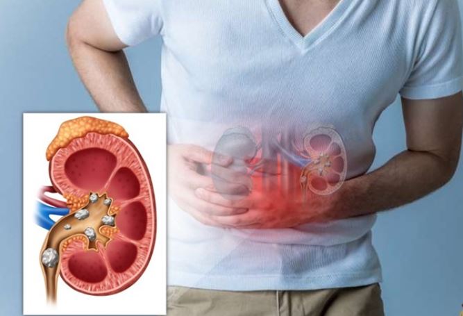 Sỏi thận có thể tự đào thải trong bao lâu, khi nào cần can thiệp?