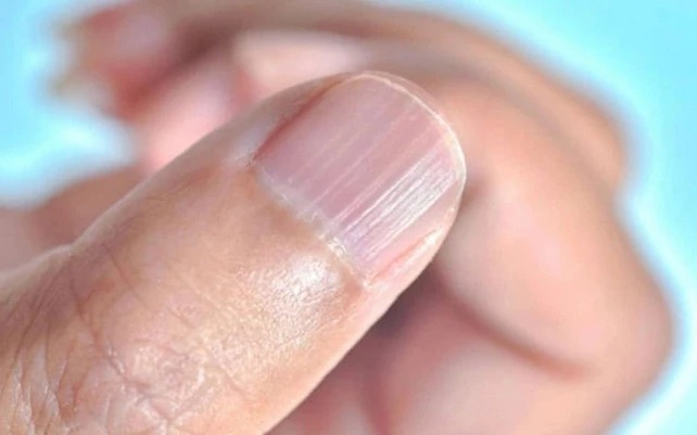 Móng tay nổi sọc dọc, cảnh báo dấu hiệu bất thường vấn đề sức khỏe