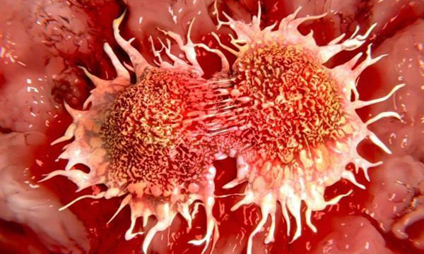 Các nhà khoa học Nga và Thụy Điển tìm ra cách tiêu diệt tế bào ung thư