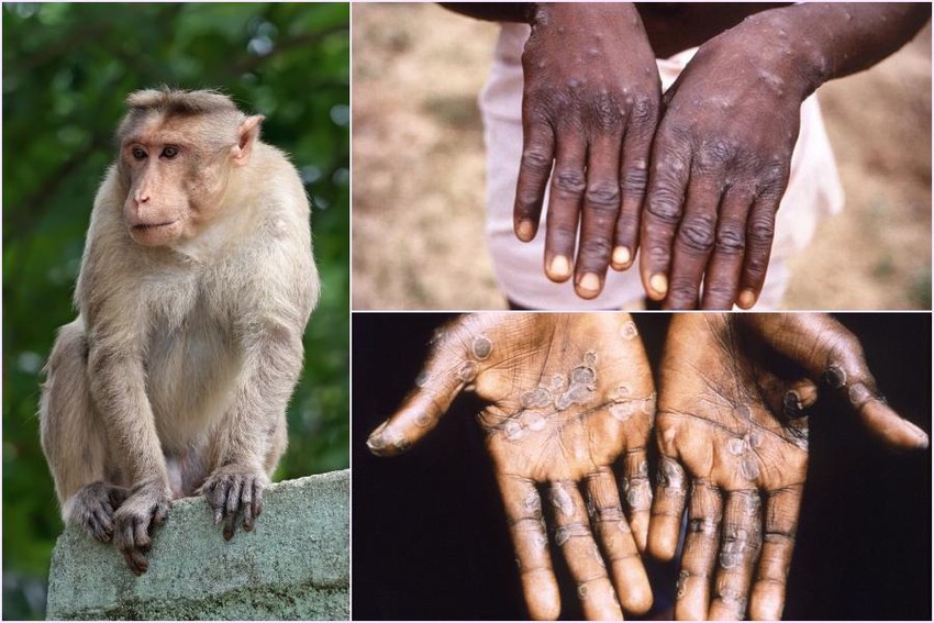 Ca đầu tiên lây virus đậu mùa khỉ từ người bệnh