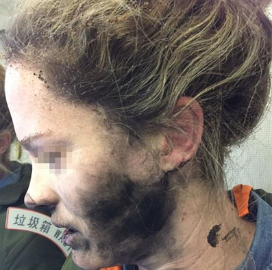 Tai nghe phát nổ trên chuyến bay từ Trung Quốc tới Úc, nữ hành khách bị bỏng nặng