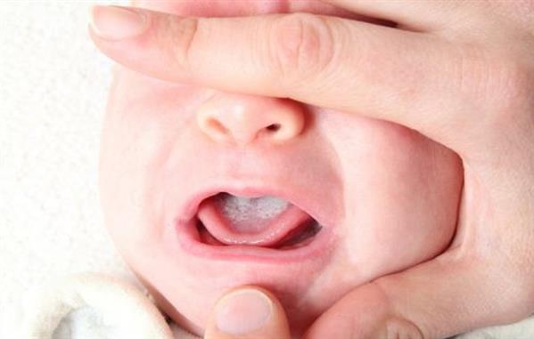 Nguyên nhân bất ngờ gây tưa lưỡi ở trẻ sơ sinh và cách phòng tránh