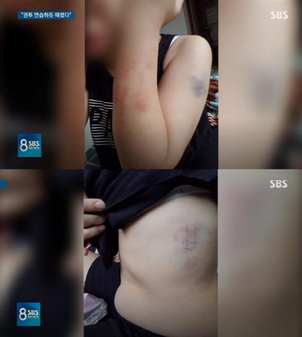 SBS công khai hình ảnh thương tích của cô dâu Việt sau khi bị chồng người Hàn bạo hành, một lần nữa khiến dân mạng căm phẫn