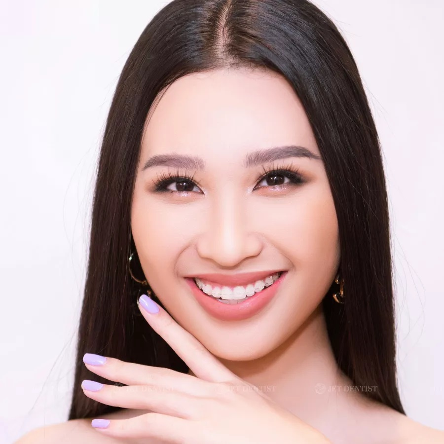 Nha khoa thẩm mỹ Jet Dentist: Niềng răng mắc cài Sapphire là gì?