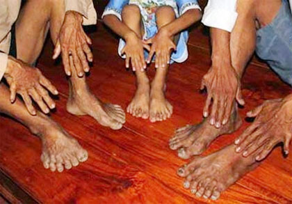 Dòng họ của những dị nhân 24 ngón tay chân
