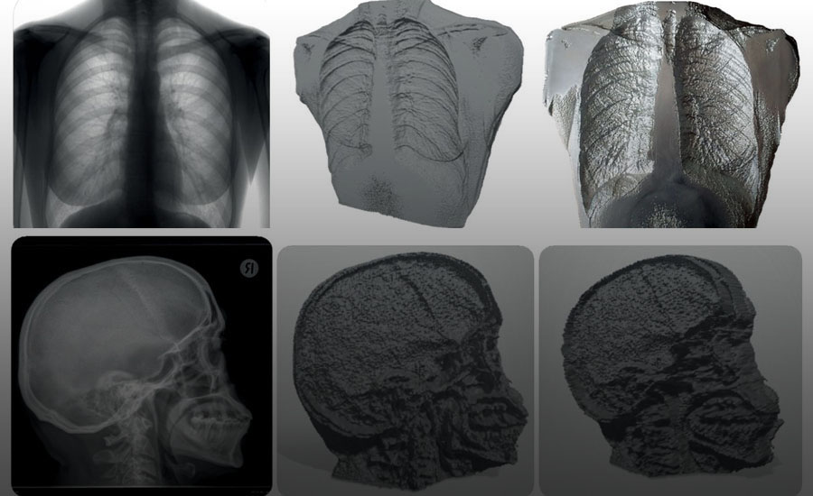 Mô hình Phantom nhôm hình người (anthropomorphic) độc đáo cho chụp X-quang kỹ thuật số lồng ngực