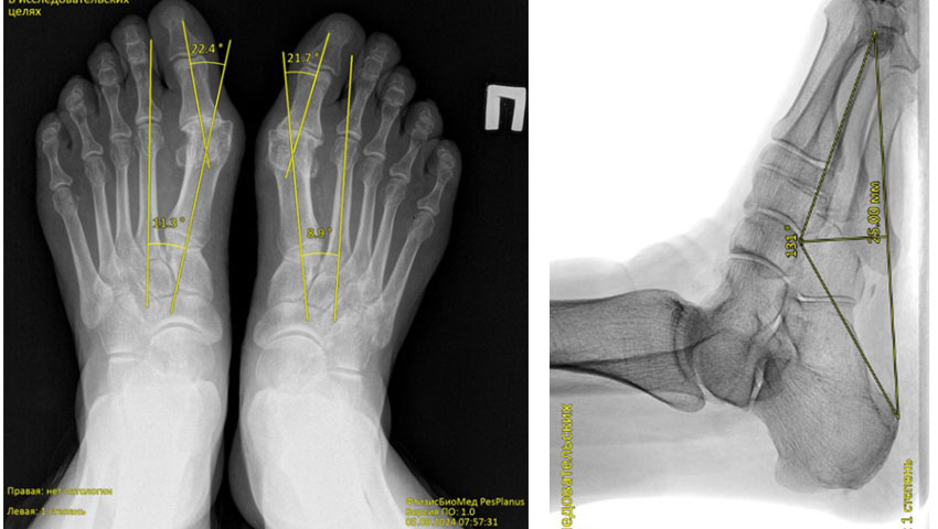 Chương trình phân tích tự động ảnh ‘X-quang bàn chân’ phát hiện bàn chân bẹt dọc và bẹt ngang